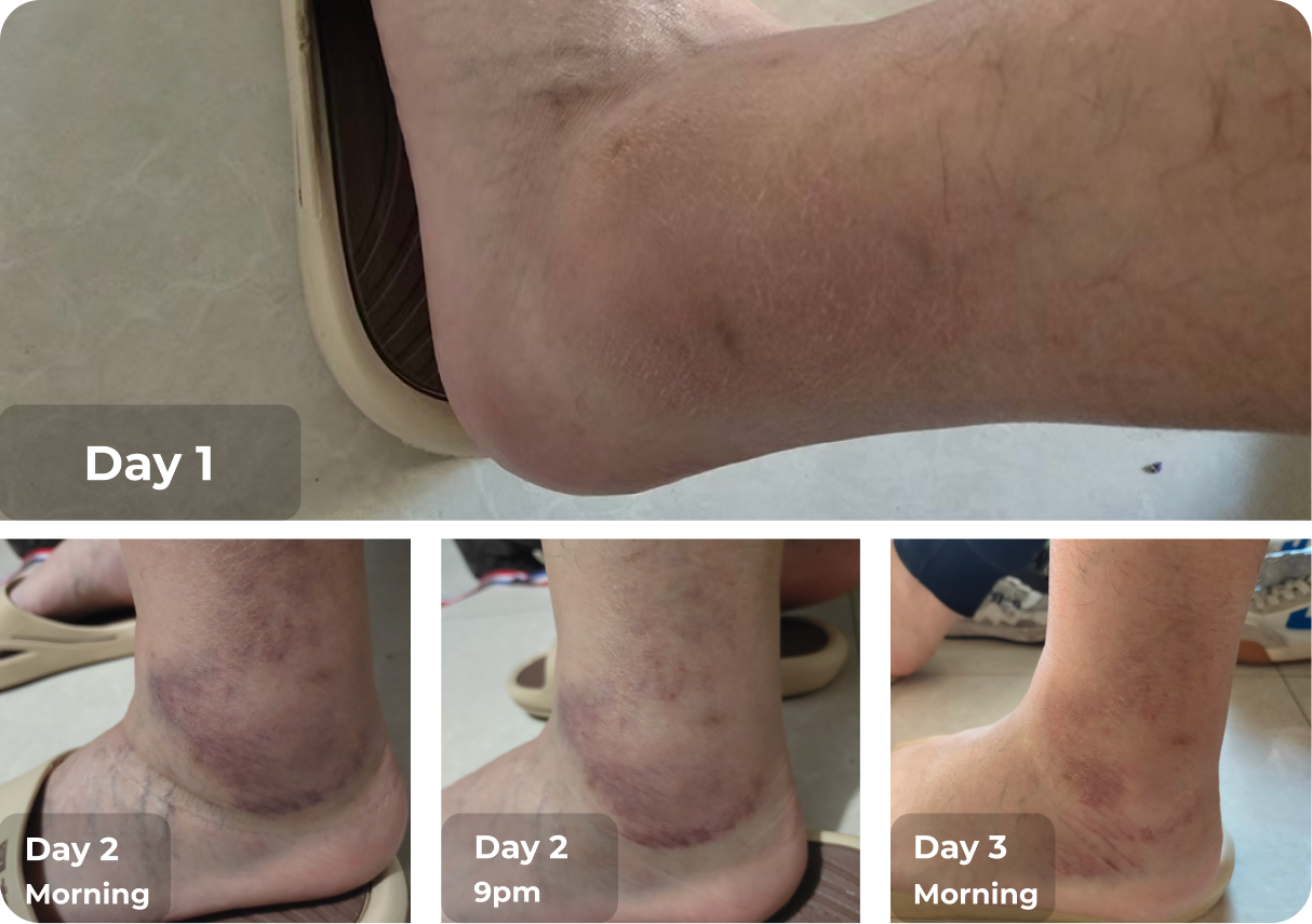 ULTRIIX For Ankle Acute Sprain