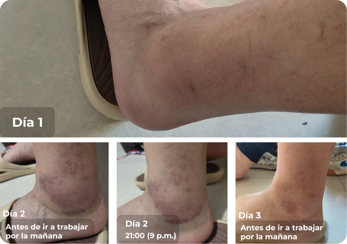 Caso de esguince de tobillo