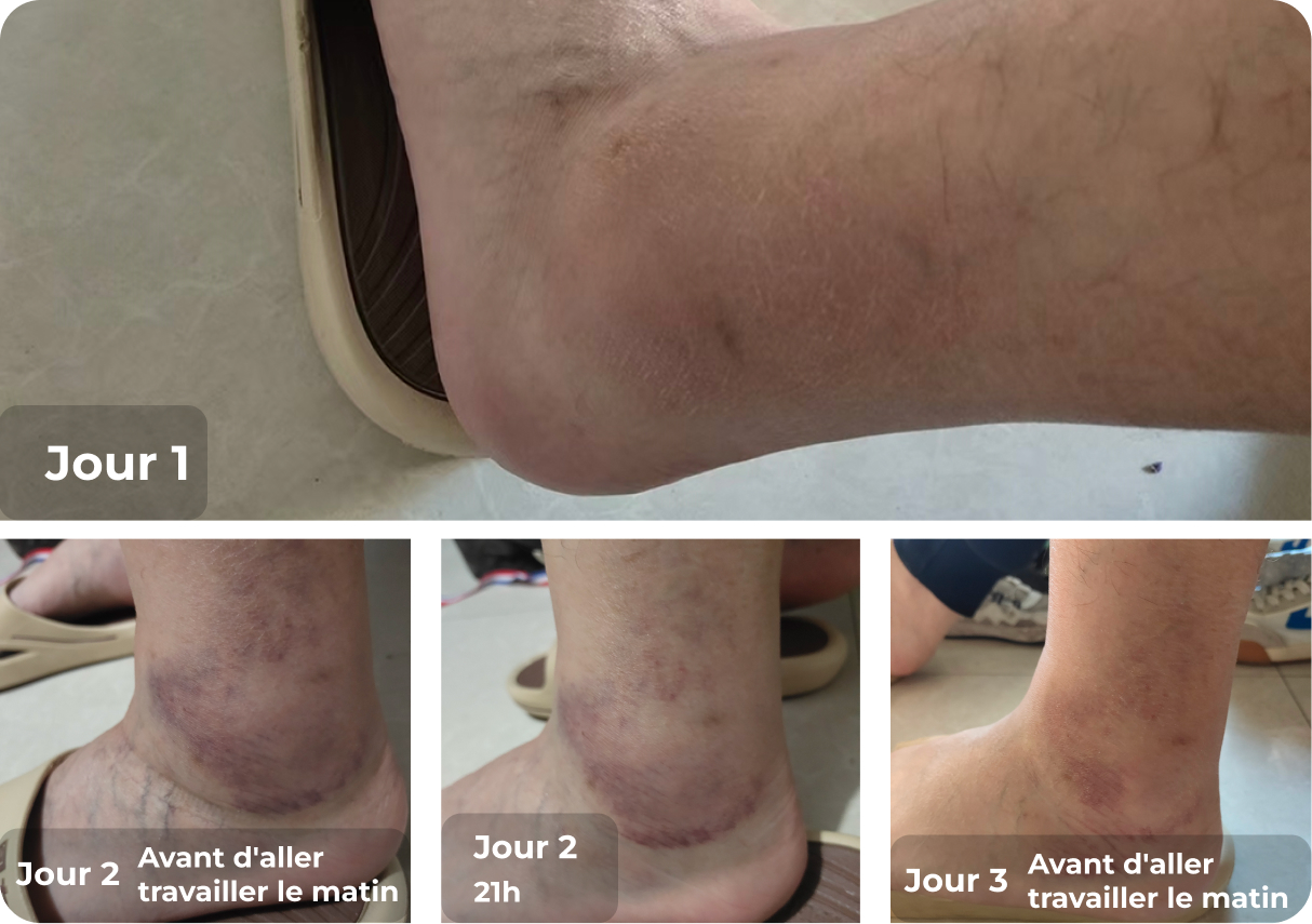 Cas d'entorse de la cheville