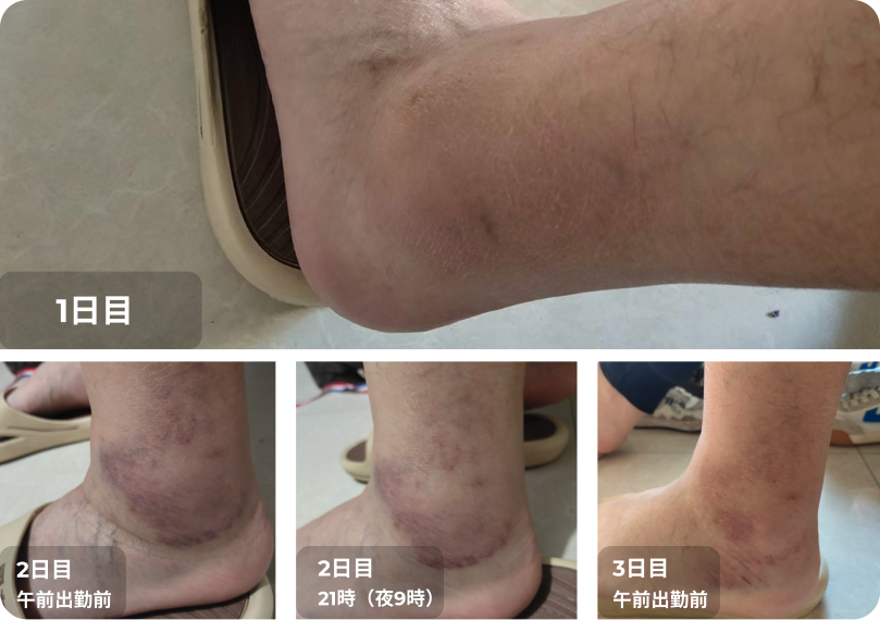 足首の捻挫案例