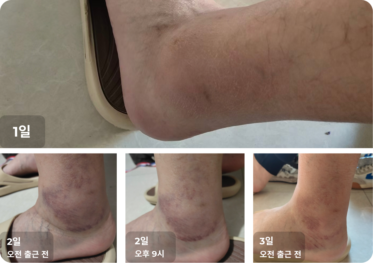 발목 염좌 사례